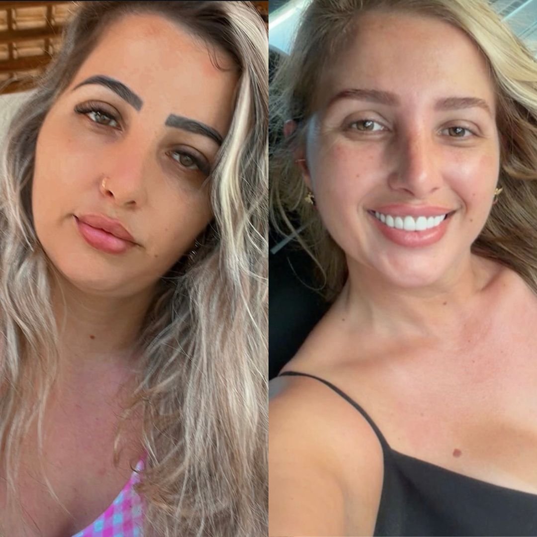 Caso Valéria — antes e depois da despigmentação e Nano Pigmentação conduzida por Mariana Souza