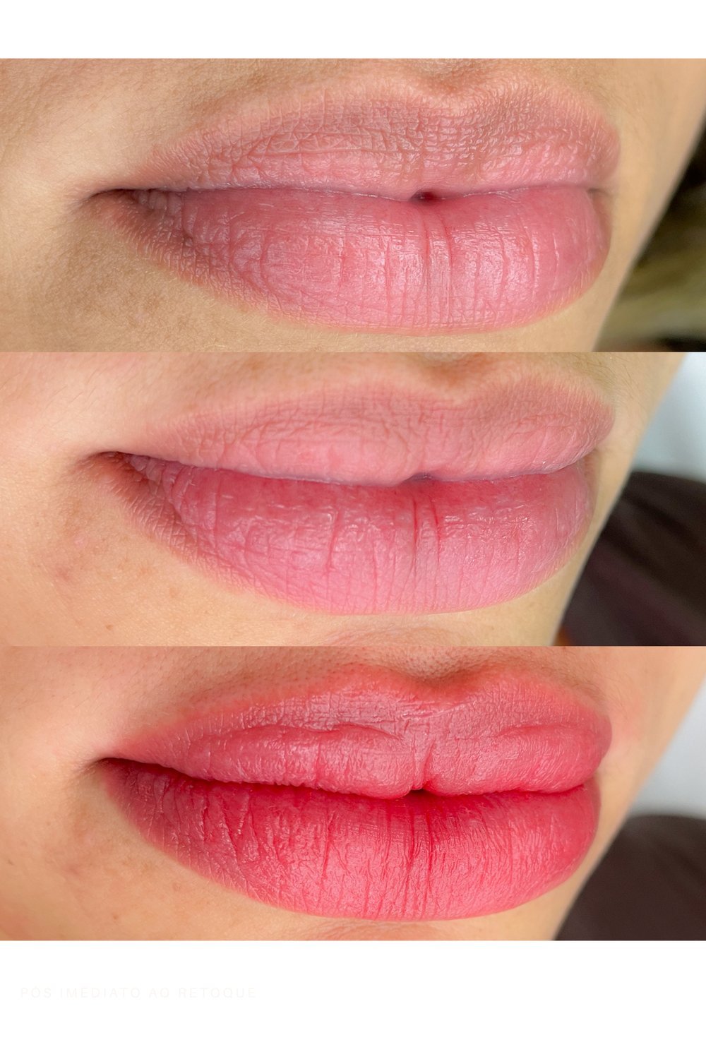 Nano Lips Labial — antes e depois da revitalização sutil dos lábios
